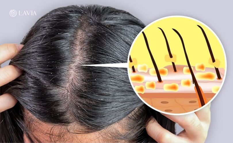 Cách chọn dầu gội trị rụng tóc da liễu phù hợp