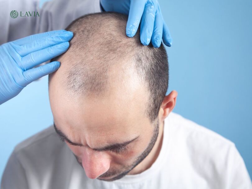 Rụng tóc do di truyền