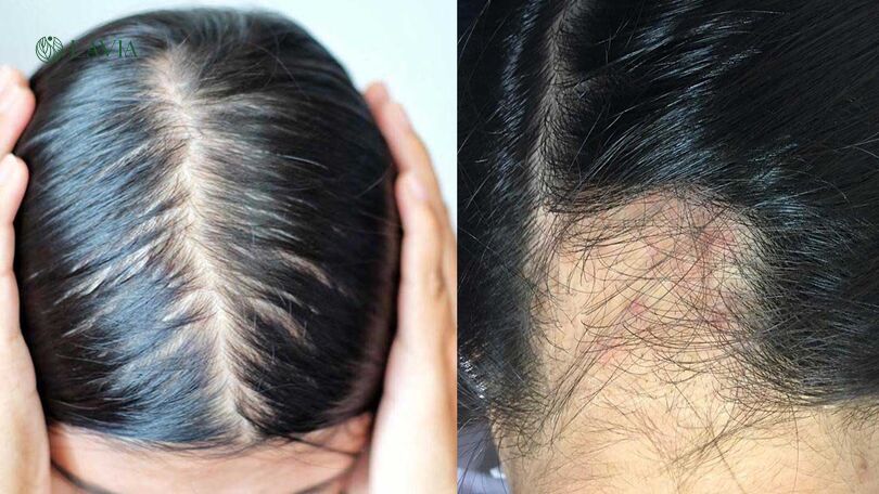III. Cách Gội Đầu Đúng Cách